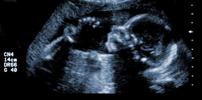 potential for mental and physical harm to women who undergo drug induced elective abortions 02