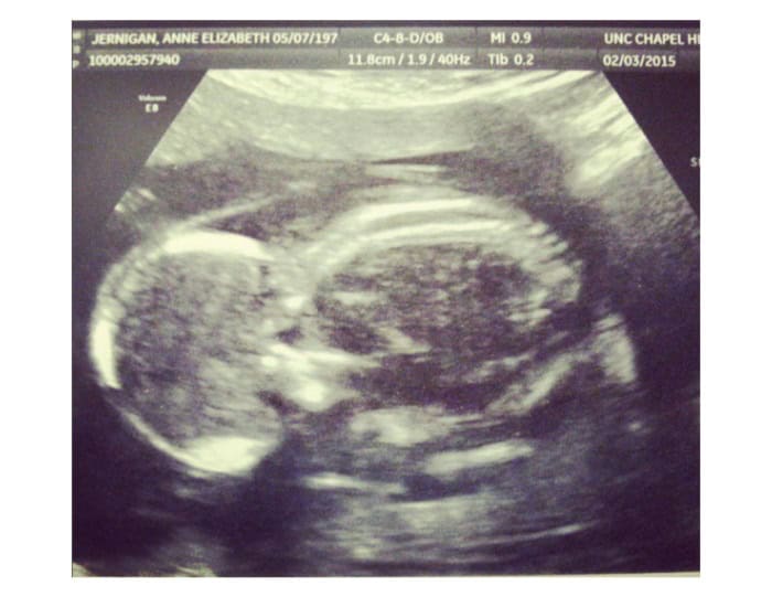 pressured abort spina bifida trisomy 18 trusted 01